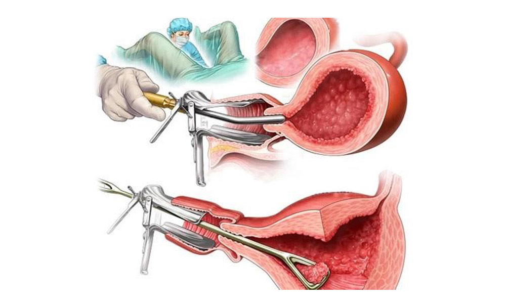 کولپوسکوپی