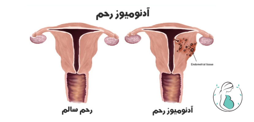 آنومیوز رحم