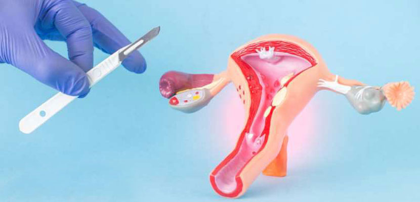 اندومتریوز رحم