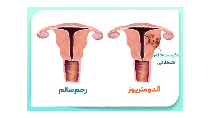اندومتریوز-رحم
