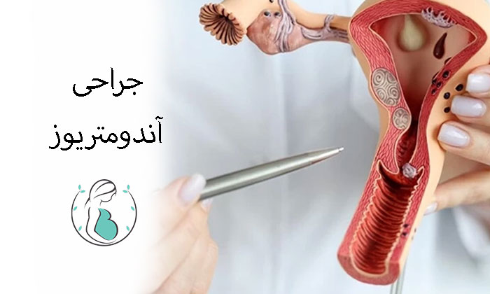 جراحی آندومتریوز