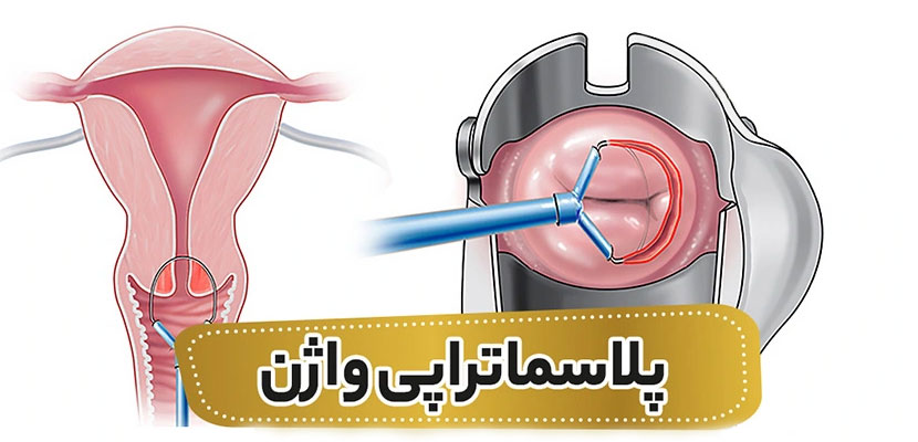 پلاسما-تراپی-واژن