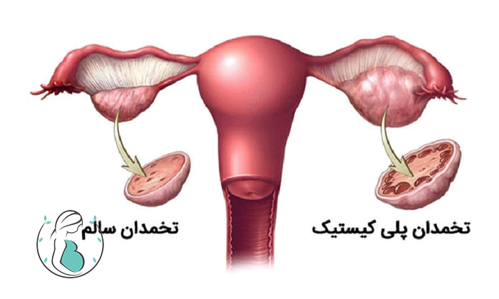 سندروم تخمدان پلی‌کیستیک