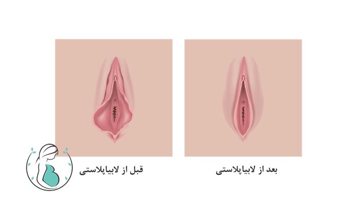 لابیاپلاستی