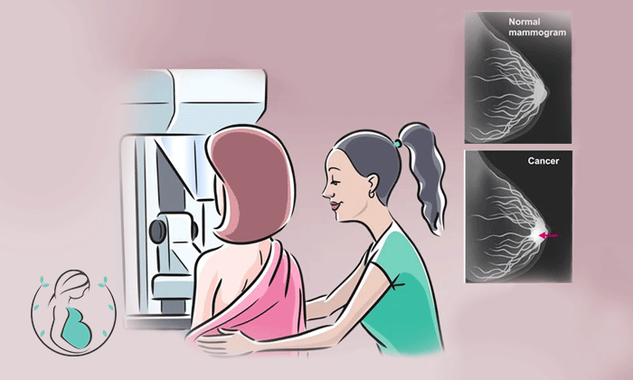 ماموگرافی