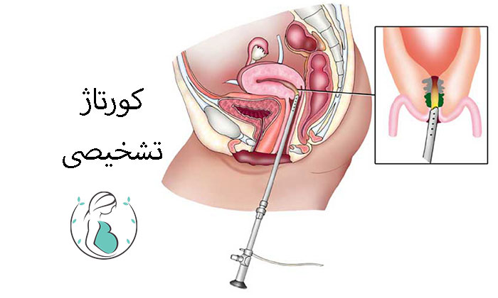 کورتاژ تشخیصی