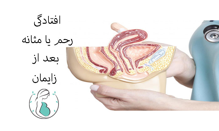 افتادگی-مثانه-یا-رحم