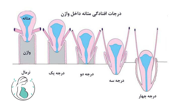 افتادگی مثانه